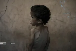 کودکان غزه در صف مرگ بدلیل سوء&zwnj;تغذیه، گرسنگی، و کمبود کمک&zwnj;ها و خدمات حیاتی