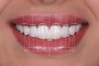 ۶۰٪ استحکام بیشتر دندان با انتخاب این کامپوزیت‌ها