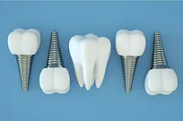 ایمپلنت مشهد