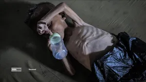 کودکانی که در غزه بر اثر گرسنگی تبدیل به اسکلت شده&zwnj;اند