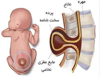 ابتلا ۲ میلیون ایرانی به «مننگوسل»/ تشخیص زودهنگام از نارسایی کلیه و دیالیز کودکان جلوگیری می‌کند