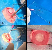 ترمیم زخم قرنیه با روش جدید در دانشگاه تهران