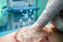 «ژل اکسیژن‌ساز»، امیدی برای جلوگیری از قطع عضو در دیابت