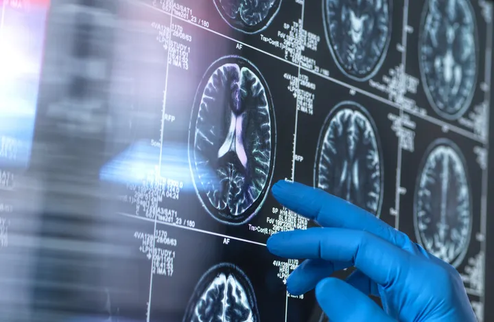 Study identifies early workplace signs of dementia up to 15 years before diagnosis