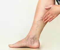 پیشگیری از ترومبوز با تحرک، تغذیه مناسب و ترک سیگار