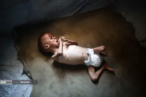 کودکانی که در غزه بر اثر گرسنگی تبدیل به اسکلت شده&zwnj;اند