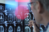Muscle loss may be an important warning sign of dementia