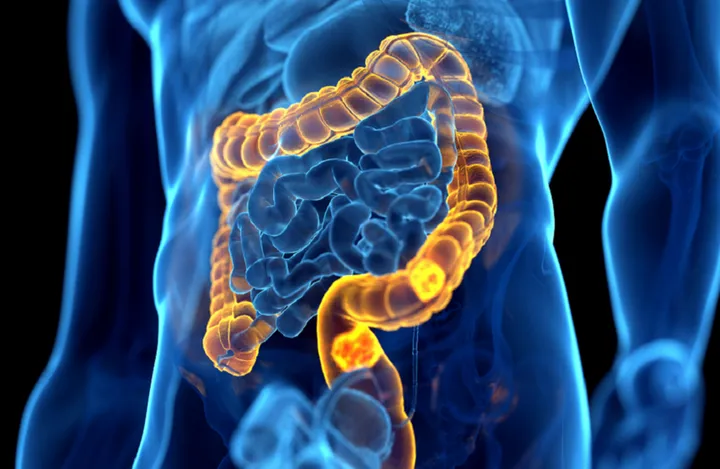 South Korean Scientists Discover Promising Way to Slow Colon Cancer Growth