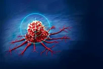 Magnetic Nano-composites Offer New Hope for Bone Cancer Treatment