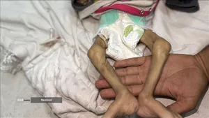 کودکانی که در غزه بر اثر گرسنگی تبدیل به اسکلت شده&zwnj;اند