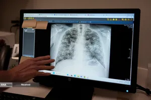 کارگران معدن زغال سنگ مبتلا به بیماری ریه سیاه با دولت ترامپ در مورد لغو حمایت&zwnj;های ایمنی مبارزه می&zwnj;کنند