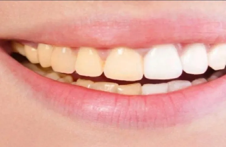 Why teeth change color and how to restore their whiteness
