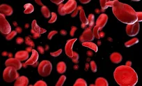 کم‌خونی داسی شکل (Sickle cell anemia) چیست؟