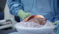 Iran expands lung transplantation with complex procedures and AI
