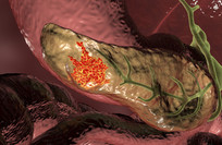 Researchers develop AI model to predict pancreatic cancer risk
