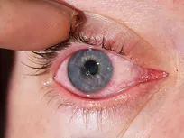 تولید زخم‌پوش دولایه با قابلیت دارورسانی کنترل‌شده برای درمان زخم‌های قرنیه در ایران