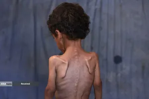 کودکانی که در غزه بر اثر گرسنگی تبدیل به اسکلت شده&zwnj;اند