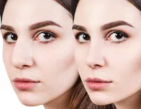 کاندید مناسب انجام عمل بینی چه کسانی هستند؟