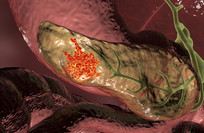 New drug nearly doubles survival in pancreatic cancer