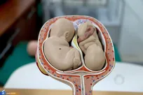 افزایش ۵ درصدی زایمان طبیعی در سال با سرمایه‌گذاری در مامایی