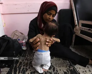 کودکانی که در غزه بر اثر گرسنگی تبدیل به اسکلت شده&zwnj;اند
