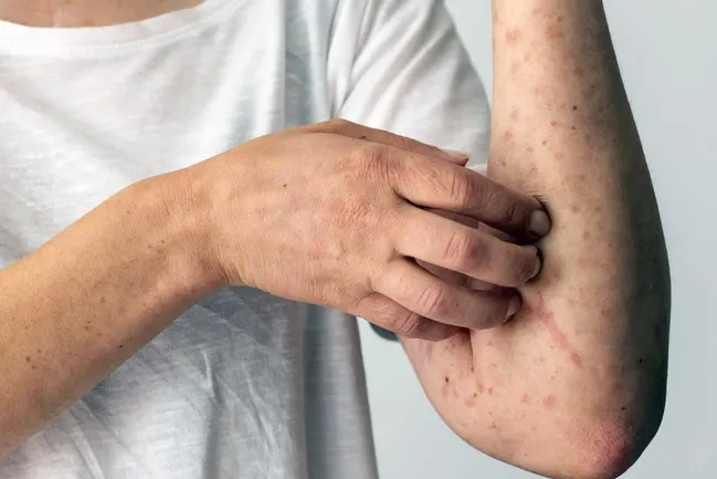 لوپوس را جدی بگیرید؛ از خستگی و درد مفاصل تا درگیری قلب و کلیه