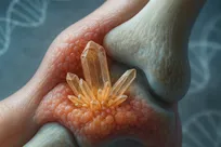 فرد مبتلا به نقرس مقصر نیست